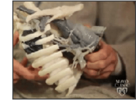 Medical-3D-Printing-Helps-Surgeons-Reduce-Complications-and-Save-Lives-5