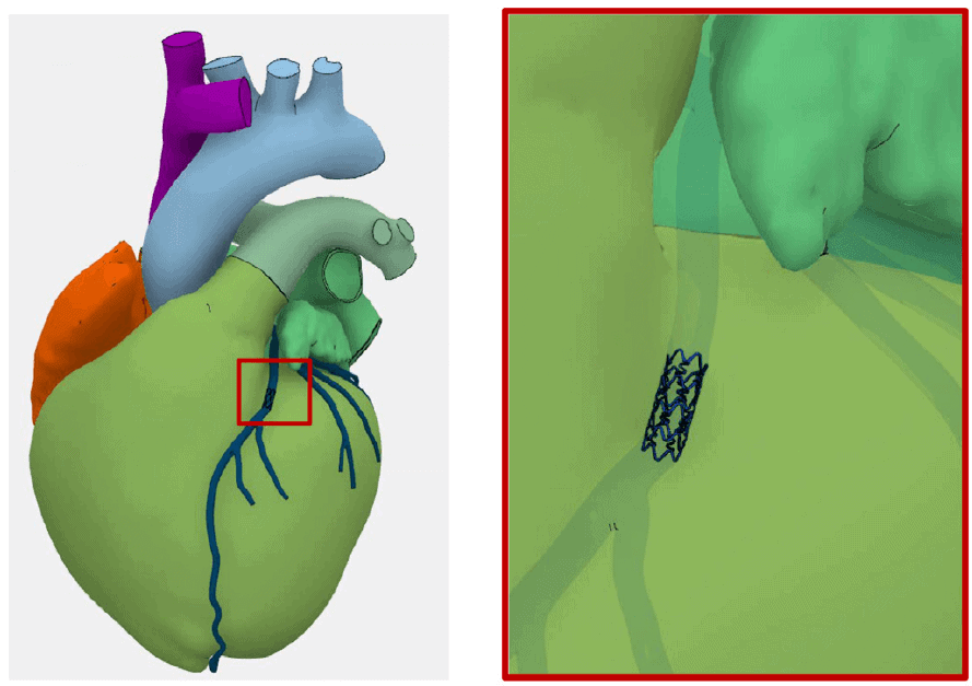 Coronary arteries (blue) and stent added to the SIMULIA Living Heart Human Model. Zoomed-in view shows the stent aligned with the coronary arteries.